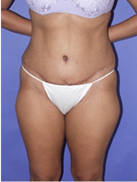 abdominoplasty (tummy tuck) patient