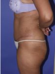 abdominoplasty (tummy tuck) patient