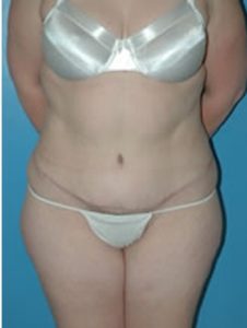 abdominoplasty (tummy tuck) patient