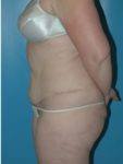 abdominoplasty (tummy tuck) patient
