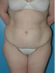 abdominoplasty (tummy tuck) patient