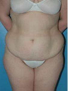 abdominoplasty (tummy tuck) patient