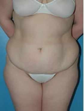 abdominoplasty (tummy tuck) patient