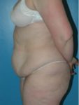 abdominoplasty (tummy tuck) patient