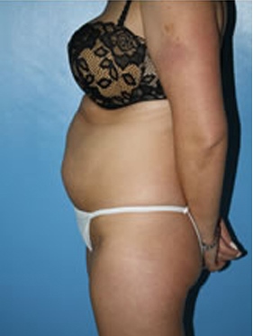 abdominoplasty (tummy tuck) patient