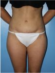 abdominoplasty (tummy tuck) patient