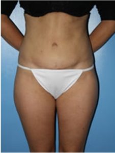 abdominoplasty (tummy tuck) patient