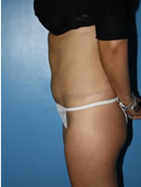 abdominoplasty (tummy tuck) patient