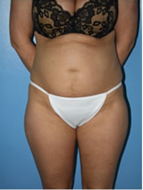 abdominoplasty (tummy tuck) patient