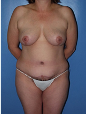 abdominoplasty (tummy tuck) patient