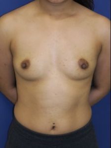 breast augmentation patient