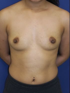 breast augmentation patient