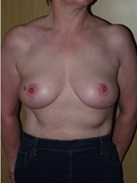 breast lift patient