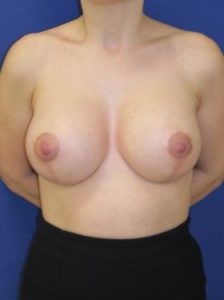 Breast lift with implants patient