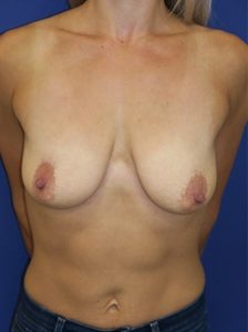 Breast lift with implants patient