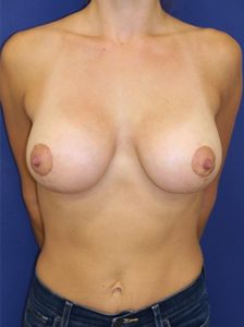 Breast lift with implants patient