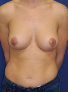 Breast lift with implants patient