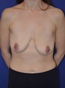 Breast lift with implants patient