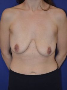 Breast lift with implants patient