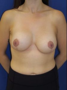 Breast lift with implants patient