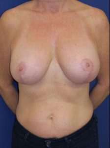 Breast lift with implants patient