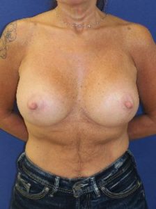 Breast lift with implants patient