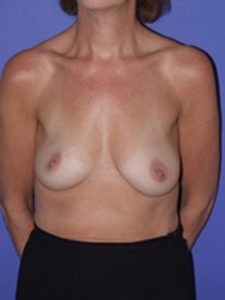 inframammary breast augmentation patient