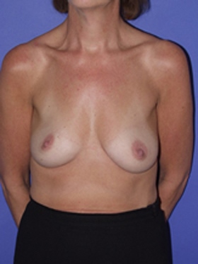 inframammary breast augmentation patient