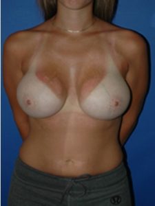 inframammary breast augmentation patient