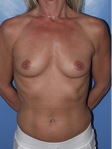 inframammary breast augmentation patient