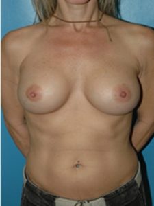 inframammary breast augmentation patient