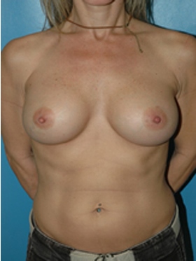 inframammary breast augmentation patient