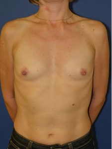 inframammary breast augmentation patient