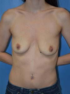 inframammary breast augmentation patient