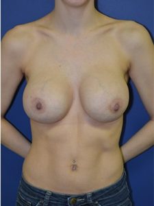 inframammary breast augmentation patient