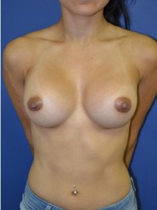 inframammary breast augmentation patient
