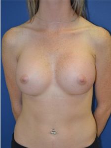 inframammary breast augmentation patient
