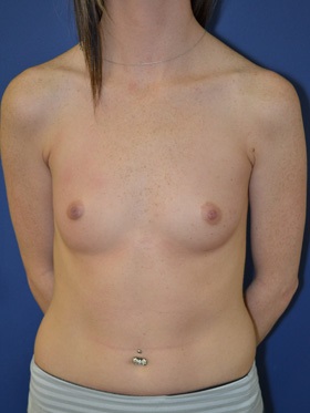 inframammary breast augmentation patient