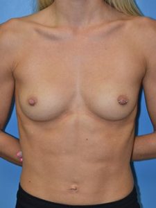 inframammary breast augmentation patient