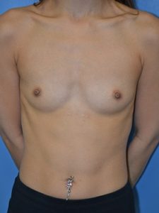 inframammary breast augmentation patient
