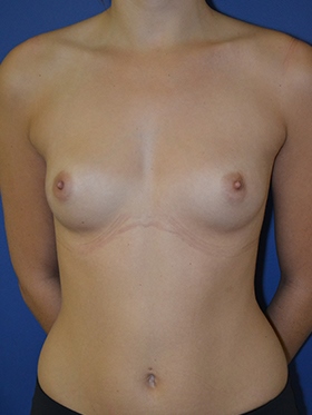 inframammary breast augmentation patient