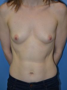 inframammary breast augmentation patient