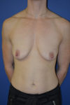 inframammary breast augmentation patient