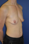 inframammary breast augmentation patient