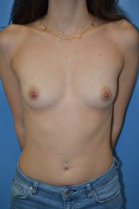 inframammary breast augmentation patient
