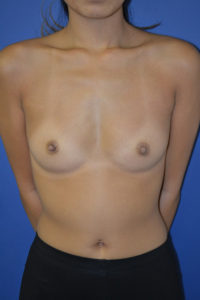 inframammary breast augmentation patient