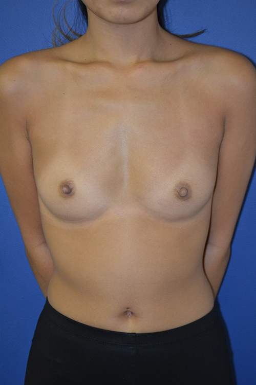 inframammary breast augmentation patient
