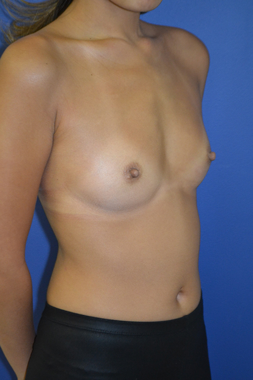 inframammary breast augmentation patient