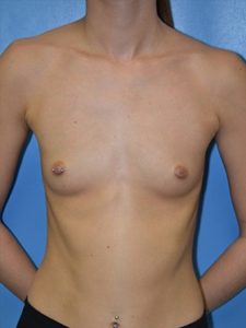 inframammary breast augmentation patient