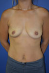 inframammary breast augmentation patient